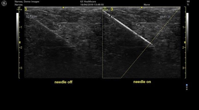 GE Clinical Ultrasound Needle Gain Enhancement Technology GE Clinical Ultrasound Needle Gain Enhancement Technology