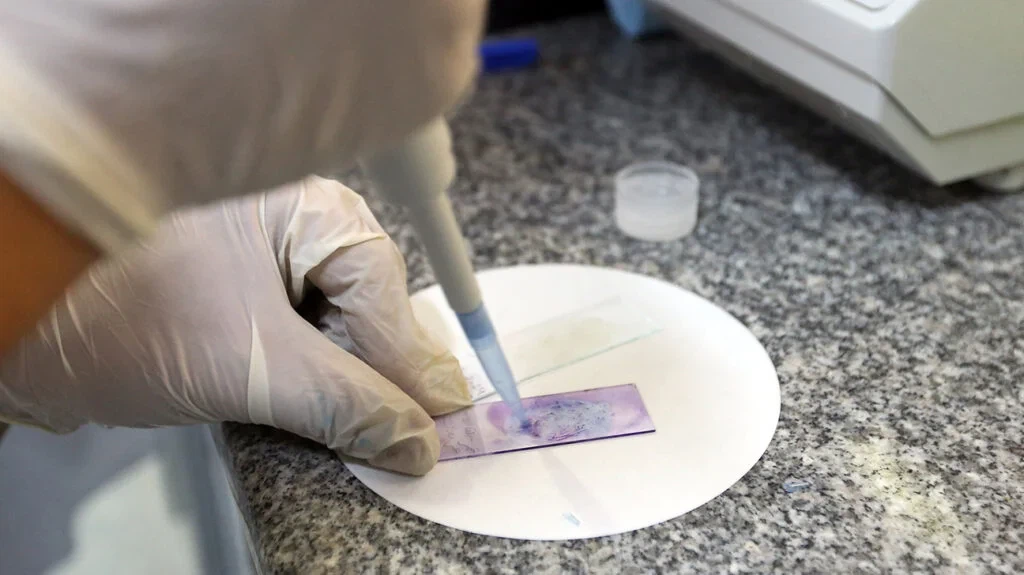 Forårsaker en biopsi kreftcelle spredt? Hva leger sier